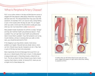 4
A Guideto P.A.D. PERIPHERAL ARTERY DISEASE A Guideto P.A.D. PERIPHERAL ARTERY DISEASE
5
What Is Peripheral Artery Disease?
P.A.D. occurs when arteries in the legs and feet become narrow or
clogged with fatty deposits called plaque. Blood flow may slowly
decrease over time. This reduced blood flow may cause only mild
symptoms. For example, P.A.D. can cause an achy, crampy feeling
or pain in the muscles when the legs are used. This can happen
when you walk or climb stairs.The discomfort usually goes away
when you rest. Such discomfort is called claudication.
Many people mistake claudication for arthritis or simply “old age”
and they don’t tell their health care professional about it. That’s
a problem! You can’t get help if your health care professional
doesn’t know there’s a problem. If you feel symptoms such as leg
muscle tiredness, aching or cramping when you walk or climb
stairs, you should be examined for P.A.D.
If the clogging in your leg arteries is severe, more serious
problems can happen. Wounds heal very slowly. Sores or ulcers
can form. Muscle tissue may die. Gangrene can set in. Toes, feet,
or parts of the leg may have to be amputated.
More importantly, the kind of blockages that cause P.A.D. can
also occur in blood vessels of the heart or brain. If a fatty deposit
or plaque breaks apart in these blood vessels, a blood clot can
form. The clot can block the flow of blood to your heart or brain,
causing a heart attack or stroke. So having P.A.D. means you are
at higher risk for these diseases too.
A healthy artery (on left) allows blood to pass easily. But a leg
artery clogged with plaque (on right) reduces blood flow, leading
to symptoms of P.A.D.
 