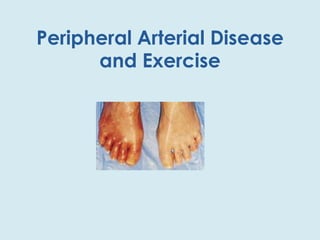 Peripheral Arterial Disease and Exercise 