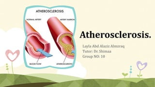 Atherosclerosis.
Layla Abd Alaziz Almzraq
Tutor: Dr. Shimaa
Group NO: 10
 