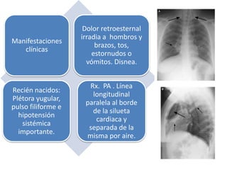 Manifestaciones 
clínicas 
Dolor retroesternal 
irradia a hombros y 
brazos, tos, 
estornudos o 
vómitos. Disnea. 
Recién nacidos: 
Plétora yugular, 
pulso filiforme e 
hipotensión 
sistémica 
importante. 
Rx. PA . Línea 
longitudinal 
paralela al borde 
de la silueta 
cardiaca y 
separada de la 
misma por aire. 
 