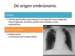 De origen embrionario. 
Etiología 
• Células germinales cuyo trayecto a lo largo del surco urogenital 
hacia la gónada primitiva quedó interrumpido a nivel 
mediastínico. 
Aparición síntomas 
• Adolescencia 
o comienzos de la edad adulta. 
 