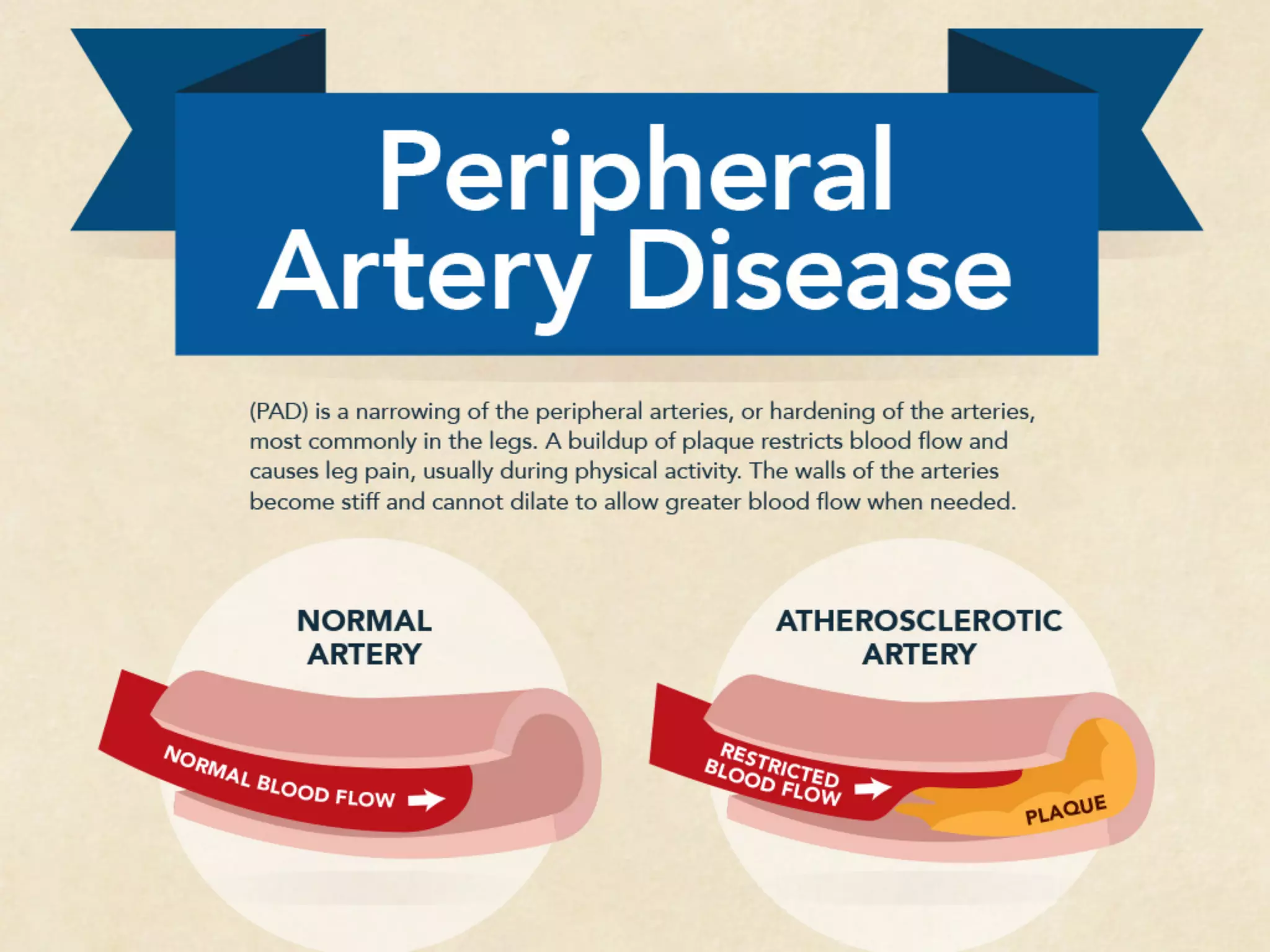 Peripheral Artery Disease [INFOGRAPHIC] | PDF