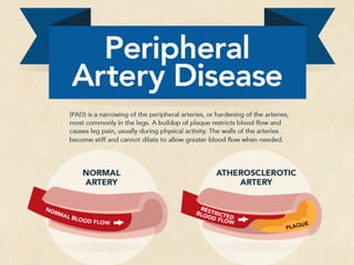 Peripheral Artery Disease [INFOGRAPHIC] | PDF