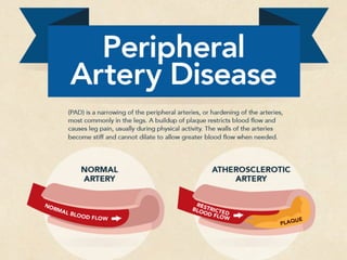Peripheral Artery Disease [INFOGRAPHIC]