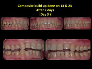 Patient came in with dislodged Composite on 23 & 42
After 1 day
(Day 4)
 