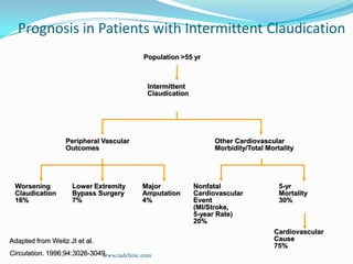 Population >55 yrIntermittentClaudicationPeripheral VascularOutcomesOther CardiovascularMorbidity/Total MortalityLower ExtremityBypass Surgery7%MajorAmputation4%WorseningClaudication16%NonfatalCardiovascularEvent(MI/Stroke, 5-year Rate)20%5-yrMortality30%CardiovascularCause75%Prognosis in Patients with Intermittent ClaudicationAdapted from Weitz JI et al. Circulation. 1996;94:3026-3049.www.radclinic.com