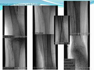 Critical Limb Ischemia/ Limb SalvageFrontrunner100% SFASFA postPatent peroneal with runoff to footSilverhawkZero runoff