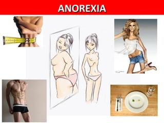 ANOREXIA
 