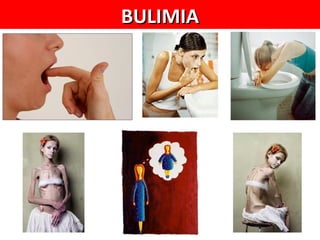 BULIMIA
 