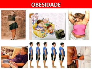 OBESIDADE
 