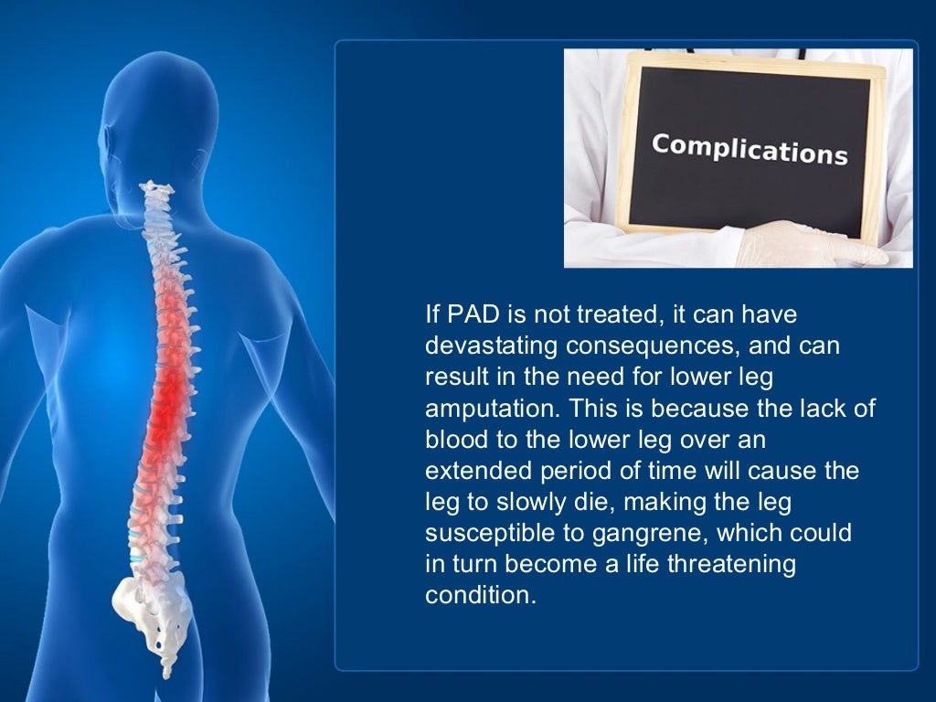 PAD Symptoms & Complications USA Vascular Centers