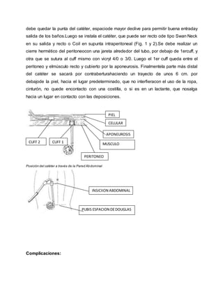 debe quedar la punta del catéter, espaciode mayor declive para permitir buena entraday
salida de los baños.Luego se instala el catéter, que puede ser recto ode tipo Swan Neck
en su salida y recto o Coil en supunta intraperitoneal (Fig. 1 y 2).Se debe realizar un
cierre hermético del peritoneocon una jareta alrededor del tubo, por debajo de 1ercuff, y
otra que se sutura al cuff mismo con vicryl 4/0 o 3/0. Luego el 1er cuff queda entre el
peritoneo y elmúsculo recto y cubierto por la aponeurosis. Finalmentela parte más distal
del catéter se sacará por contraberturahaciendo un trayecto de unos 6 cm. por
debajode la piel, hacia el lugar predeterminado, que no interfieracon el uso de la ropa,
cinturón, no quede encontacto con una costilla, o si es en un lactante, que nosalga
hacia un lugar en contacto con las deposiciones.
Posición del catéter a través de la Pared Abdominal
Complicaciones:
MUSCULOCUFF 1CUFF 2
PERITONEO
APONEUROSIS
CELULAR
PIEL
PUBIS ESPACION DEDOUGLAS
INSICIION ABDOMINAL
 