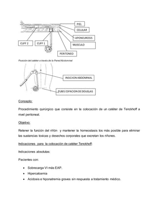 Posición del catéter a través de la Pared Abdominal
Concepto:
Procedimiento quirúrgico que consiste en la colocación de un catéter de Tenckhoff a
nivel peritoneal.
Objetivo:
Retener la función del riñón y mantener la homeostasis los más posible para eliminar
las sustancias toxicas y desechos corporales que excretan los riñones.
Indicaciones para la colocación de catéter Tenckhoff:
Indicaciones absolutas:
Pacientes con:
 Sobrecarga VI más EAP.
 Hipercalcemia
 Acidosis e hiponatremia graves sin respuesta a tratamiento médico.
PIEL
CELULAR
APONEUROSIS
PERITONEO
CUFF 2 CUFF 1
INSICIION ABDOMINAL
PUBIS ESPACION DEDOUGLAS
MUSCULO
 