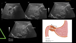paed high yield git, scurvy , rickets radiology | PPTX