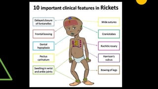 paed high yield git, scurvy , rickets radiology | PPTX