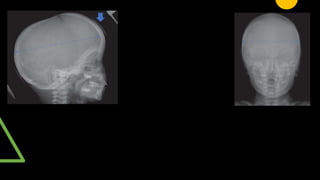 paed high yield git, scurvy , rickets radiology | PPTX