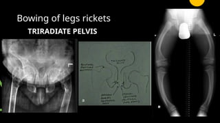 paed high yield git, scurvy , rickets radiology | PPTX