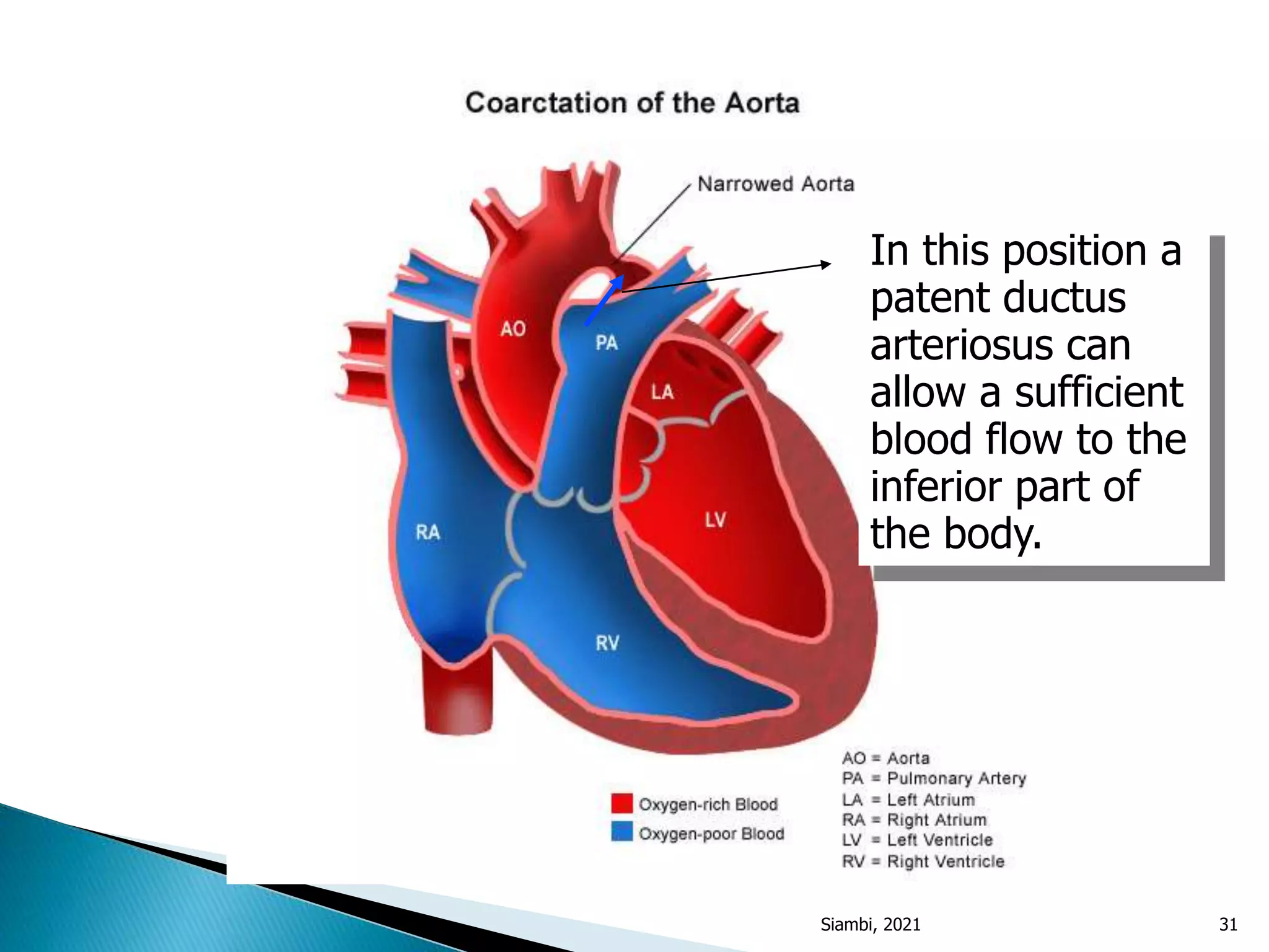 In this position a
patent ductus
arteriosus can
allow a sufficient
blood flow to the
inferior part of
the body.
Siambi, 2021 31
 