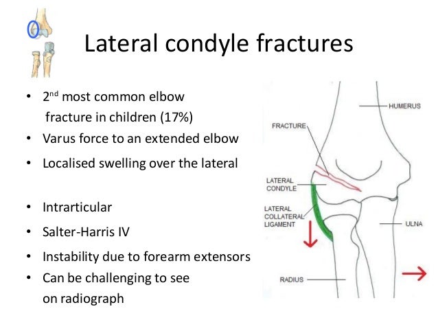 paediatric elbow fractures