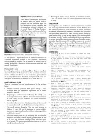 •	 Neurological injury due to injection of incorrect solutions.
	 Great care must be taken at all times in preparation and checking
	 of drugs.
CONCLUSION
In our experience, the incidence of serious complications associated
with SA is very low even in small premature infants. We think that
this technique provides a good alternative to general anaesthesia
in newborns with increased anaesthesia-related risk and for infants
undergoing lower abdominal or lower extremity surgery during the
first 6 months of life. SA may be used to avoid GA in patients outside
the neonatal period, if needed combined with intravenous sedation.
SA is most successful as a single shot technique, limited to surgery
lasting less than 90 minutes. SA in children requires the technical
skills of experienced anaesthesia providers. Neonates and infants are
at high risk of complications during surgery, irrespective of the type
of anaesthesia, and the presence of clinician trained in paediatric
anaesthesiology is mandated.
REFERENCES
1.	 Tyrell-Gray H. A study of spinal anaesthesia in children and infants.
	 Lancet 1909; 2: 913-7.
2.	 Abajian JC, Mellish RW, Browne AF, Perkins FM, Lambert DH, Mazuzan
	 JE. Spinal anesthesia for surgery in the high risk infant. Anesth Analg
	 1984; 63: 359-62.
3.	 Welborn LG, Rice LJ, Hannalah RS, Broadman LM, Ruttimann VE, Fink R.
	 Post-operative apnea in former infants: prospective comparison of
	 spinal and general anesthesia. Anesthesiology 1990; 72: 838-42.
4.	 Tobias JD. Spinal anaesthesia in infants and children. Paediatric
	 Anaesth 2000; 10: 5-16.
5.	 Dalens B, Veyckemans F. Traité d’Anesthésie Loco-Régionale, de la
	 naissance à l’âge adulte. Montpellier: Sauramps Médical 2008,
	 463-512.
6.	 Dalens B, Tanguy A. Intrathecal morphine for spinal fusion in children.
	 Spine 1988: 13: 494-7.
7.	 Gall O, Aubineau JV, Bernière J, Desjeux L, Murat I. Analgesic effect
	 of low dose intrathecal morphine after spinal infusion in children.
	 Anesthesiology 2001; 94: 447-52.
8.	 Berde C, Sethna N, Conrad LS, Hershenson MB. Subarachnoid
	 bupivacaine analgesia for seven months for a patient with a spinal
	 cord tumour. Anesthesiology 1990; 72: 1094-6.
9.	 Kowalewski R, MacAdams C, Froelich J, Neil S, Maitland A. Anesthesia
	 supplemented with subarachnoid bupivacaine and morphine
	 for coronary artery bypass surgery in a child with Kawasaki disease. J
	 cardiothor Vasc Anesth 1996; 10: 243-6.
10.	 Blaise GA, Roy WL. Spinal anaesthesia for minor paediatric surgery.
	 Canadian Journal of Anaesthesia 1986; 32: 227-30.
11.	 Arthurs, Murray M, Zubier M, Tooley J, Kelsall W. Ultrasonographic
	 determination of neonatal spinal canal depth. Archives of Disease in
	 Childhood - Fetal and Neonatal Edition 2008; 93: F451-4.
12.	 Dohi S, Naito H, Takahashi T. Age-related changes in blood pressure
	 and duration of motor blockade in spinal anesthesia. Anesthesiology
	 1979; 50: 319-23.
13.	 Oberlander TF, Berde CB, Lam KH, Rappaport LA, Saul JP. Infants tolerate
	 spinal anesthesia with minimal overall autonomic changes: analysis of
	 heart rate variability in former preterm infants undergoing hernia
	 repair. Anesth Analg 1995; 80: 20-7.
14.	 Mahe V, Ecoffey C. Spinal anesthesia with isobaric bupivacaine in
	 infants. Anesthesiology 1988; 68: 601-3.
15.	 Disma N, Tuo P, Astuto M, Davidson AJ. Depth of sedation using cerebral
	 index in infants undergoing spinal anaesthesia. Pediatric Anesthesia
	 2009; 19: 133-7.
16.	 Wee LH, Lam F, Cranston AJ. The incidence of post dural puncture
	 headache in children. Anaesthesia 1996; 51: 1164-6.
Figure 3. Lumbar puncture and LA injection with 1ml syringe
SA may produce a degree of sedation in newborns and infants so
additional intravenous sedation is not required.15
Intravenous
sedation should be avoided if at all possible in infants at risk of
apnoea. We find that a dummy in dipped sucrose or honey will help
to settle these infants.
Postoperative care
In our hospital, children are discharged from the post anaesthesia
care unit when the block disappears, i.e. free lower limb movement
returns. Children are allowed to feed on demand, provided there
are no surgical restrictions. All infants younger than 60 weeks post
conception are monitored on the ward for 24 hours after SA.
COMPLICATIONS OF SA
There are a number of potential complications of SA that are listed
below:
•	 Potential traumatic puncture with spinal damage. Careful
	 technique with the appropriate equipment and a trained
	 assistant is essential
•	 Respiratory (+/-cardiovascular) insufficiency due to high SA or
	 secondary to intravenous sedation. Resuscitation measures must
	 be taken (ABC) - tracheal intubation and volume resuscitation
	 may be required.
•	 Convulsions due to overdose of local anaesthetic. All doses should
	 be calculated carefully and checked with another practitioner.
•	 Post dural puncture headache. This has been reported in
	 children >8 years old, but the incidence in younger children
	 is unknown, in part since headaches in infants and young children
	 are difficult to assess.5,16
•	 Infectious complications such as meningitis. The incidence like
	 meningitis is very low – careful aseptic technique must be used
	 at all times and multidose ampules of local anaesthetic must
	 never be used. We suggest repeating lumbar puncture in patients
	 who develop fever after SA.4,5
page 24Update in Anaesthesia | www.anaesthesiologists.org
Figure 2. Different types of SA needles
A free flow of cerebrospinal fluid should
be obtained when the spinal needle is
advanced into the intrathecal space. The
local anaesthetic syringe is attached and
the anaesthetic solution is injected over
30 seconds (Figure 3). The legs should not
be lifted after the spinal injection has been
administered, otherwise an excessively
high block will develop.
 