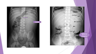 Paediatric abdominal x-ray-A key to diagnosis.pptx