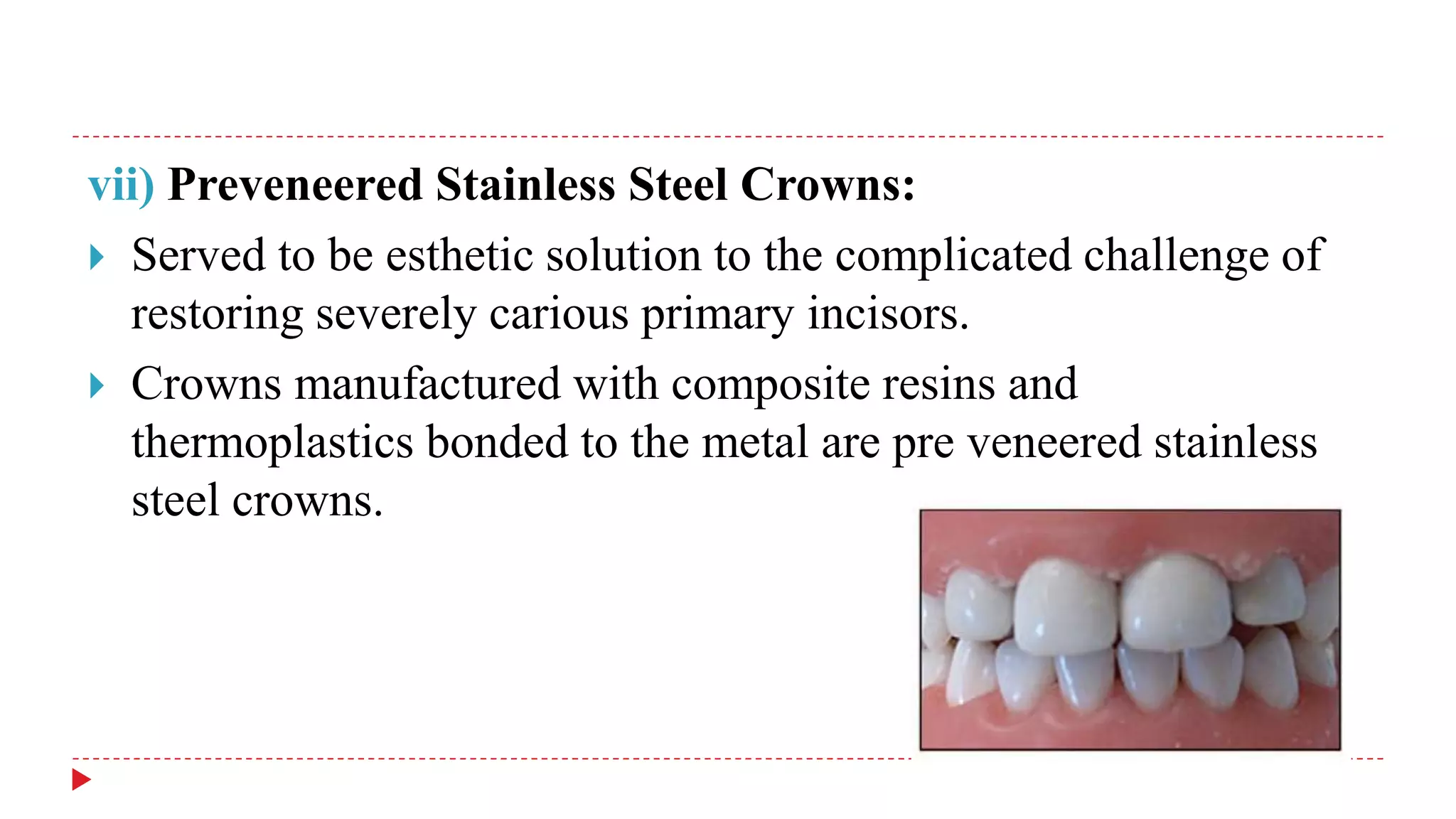 vii) Preveneered Stainless Steel Crowns:
 Served to be esthetic solution to the complicated challenge of
restoring severely carious primary incisors.
 Crowns manufactured with composite resins and
thermoplastics bonded to the metal are pre veneered stainless
steel crowns.
 