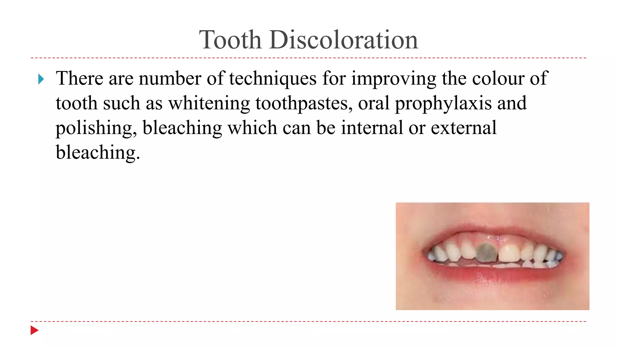 Tooth Discoloration
 There are number of techniques for improving the colour of
tooth such as whitening toothpastes, oral prophylaxis and
polishing, bleaching which can be internal or external
bleaching.
 