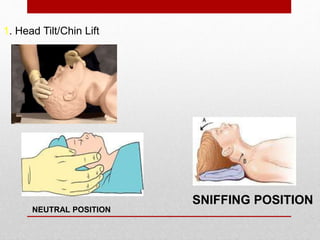 1. Head Tilt/Chin Lift
NEUTRAL POSITION
SNIFFING POSITION
 
