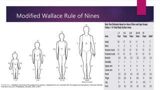 Modified Wallace Rule of Nines
 