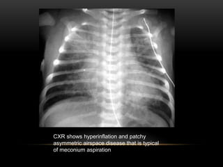 CXR shows hyperinflation and patchy
asymmetric airspace disease that is typical
of meconium aspiration
 