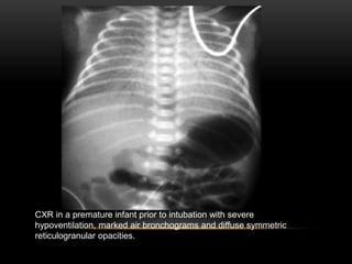 CXR in a premature infant prior to intubation with severe
hypoventilation, marked air bronchograms and diffuse symmetric
reticulogranular opacities.
 