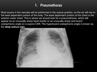 1. Pneumothorax
Most exams in the neonate will be performed in the supine position, so the air will rise to
the least dependent portion of the body. The least dependent portion of the chest is the
anterior, lower chest. This is where we should look for a pneumothorax, which will
appear as an unusually sharp heart border or an unusually sharp and lucent
costophrenic angle on a supine CXR. The hyperlucent costophrenic angle is known as
the deep sulcus sign.
 
