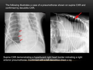 The following illustrates a case of a pneumothorax shown on supine CXR and
confirmed by decubitis CXR,
Supine CXR demonstrating a hyperlucent right heart border indicating a right
anterior pneumothorax. Confirmed with a left decubitus chest x ray
 