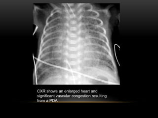 CXR shows an enlarged heart and
significant vascular congestion resulting
from a PDA
 