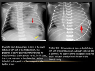 Postnatal CXR demonstrates a mass in the lower
left chest with shift of the mediastinum. The
presence of bowel gas (red arrow) indicates the
mass is due to a diaphragmatic hernia. In this case,
the stomach remains in the abdominal cavity as
indicated by the position of the nasogastric tube
(yellow arrow)
Another CXR demonstrates a mass in the left chest
with shift of the mediastinum. Although no bowel gas
is identified, the position of the nasogastric tube (red
arrow) indicates the stomach is located in the
thoracic cavity
 
