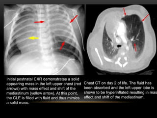 Initial postnatal CXR demonstrates a solid
appearing mass in the left upper chest (red
arrows) with mass effect and shift of the
mediastinum (yellow arrow). At this point,
the CLE is filled with fluid and thus mimics
a solid mass.
Chest CT on day 2 of life. The fluid has
been absorbed and the left upper lobe is
shown to be hyperinflated resulting in mas
effect and shift of the mediastinum.
 