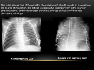 The initial assessment of the pediatric chest radiograph should include an evaluation of
the degree of inspiration. It is difficult to obtain a full inspiratory film in the younger
pediatric patient, and the radiologist should not confuse an expiratory film with
pulmonary pathology
Normal Inspiratory CXR Example of an Expiratory Exam
 