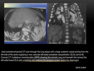 Axial contrast-enhanced CT scan through the lung bases with a large systemic vessel arising from the
left side of the aorta supplying a very vascular left-sided extralobar sequestration (ELS) (arrow B)
Corona) CT multiplanar reconstruction (MPR) showing the normal Lung and beneath this (arrow) the
left-sided basal ELS with a draining vein entering the azygous system below the diaphragm
david sutton
 