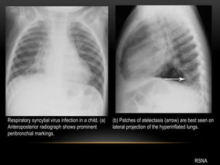 Respiratory syncytial virus infection in a child. (a)
Anteroposterior radiograph shows prominent
peribronchial markings.
(b) Patches of atelectasis (arrow) are best seen on
lateral projection of the hyperinflated lungs.
RSNA
 