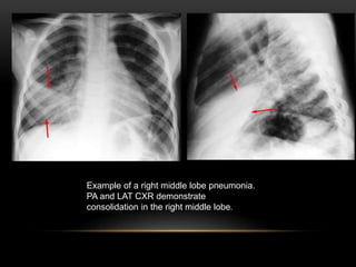 Example of a right middle lobe pneumonia.
PA and LAT CXR demonstrate
consolidation in the right middle lobe.
 