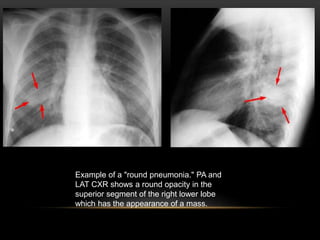 Example of a "round pneumonia." PA and
LAT CXR shows a round opacity in the
superior segment of the right lower lobe
which has the appearance of a mass.
 