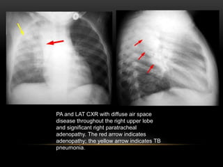 PA and LAT CXR with diffuse air space
disease throughout the right upper lobe
and significant right paratracheal
adenopathy. The red arrow indicates
adenopathy; the yellow arrow indicates TB
pneumonia.
 