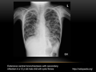 Extensive central bronchiectasis with secondary
infection in a 12 yr old male child with cystic fibrosis https://radiopaedia.org/
 