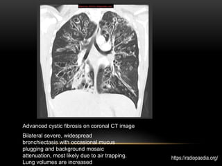 Bilateral severe, widespread
bronchiectasis with occasional mucus
plugging and background mosaic
attenuation, most likely due to air trapping.
Lung volumes are increased
Advanced cystic fibrosis on coronal CT image
https://radiopaedia.org/
 
