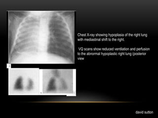 Chest X-ray showing hypoplasia of the right lung
with mediastinal shift to the right.
VQ scans show reduced ventilation and perfusion
to the abnormal hypoplastic right lung (posterior
view
david sutton
 