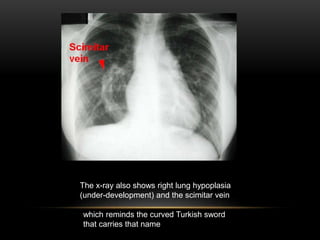 The x-ray also shows right lung hypoplasia
(under-development) and the scimitar vein
which reminds the curved Turkish sword
that carries that name
 