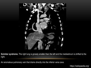 Scimitar syndrome, The right lung is grossly smaller than the left and the mediastinum is shifted to the
right.
An anomalous pulmonary vein that drains directly into the inferior vena cava.
https://radiopaedia.org/
 