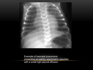 Example of neonatal pneumonia
presenting as patchy, asymmetric opacities
with a small right pleural effusion.
 