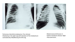 Paediatric chest by Dr. Kamal | PPTX