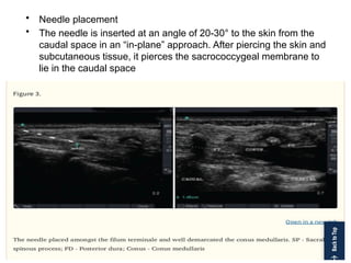 • Needle placement
• The needle is inserted at an angle of 20-30° to the skin from the
caudal space in an “in-plane” approach. After piercing the skin and
subcutaneous tissue, it pierces the sacrococcygeal membrane to
lie in the caudal space
 